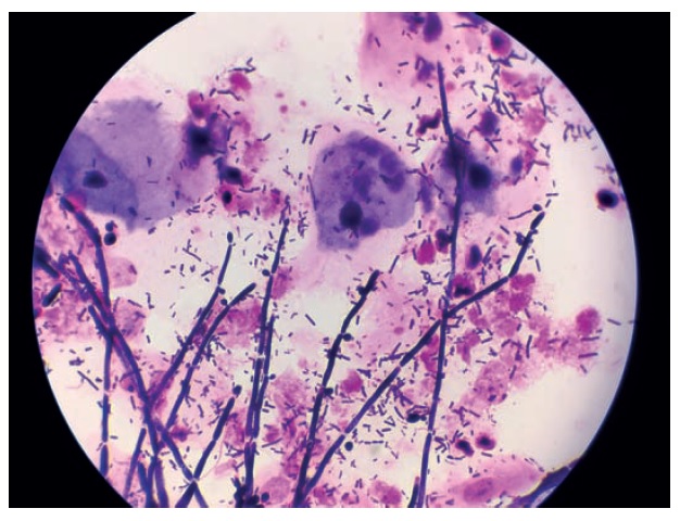 Fot. 3. Mikroflora mieszana – obraz mikroskopowy bakterii
gram-ujemnych, gram-dodatnich oraz konidiów grzybów
(barwienie złożone)